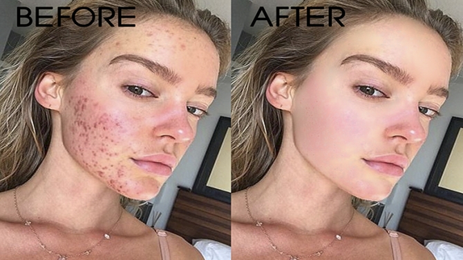 X&oacute;a mụn , chi tiết thừa