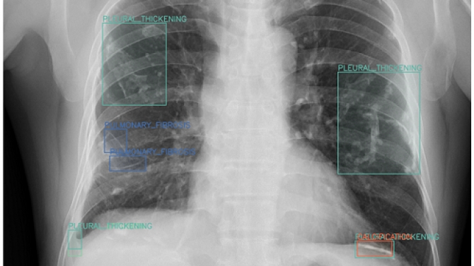 Hệ thống AI hỗ trợ chẩn đo&aacute;n ảnh X-ray phổi (Detection + LLM Reasoning)